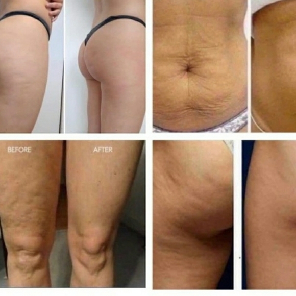 Dermatic Effects Cellulite Cream - Picture 4 of 6